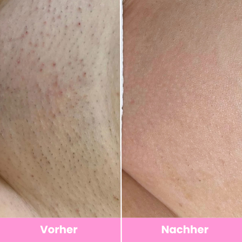 Lunelle™ Haarentfernungs-Set für glatte Haut im Sommer