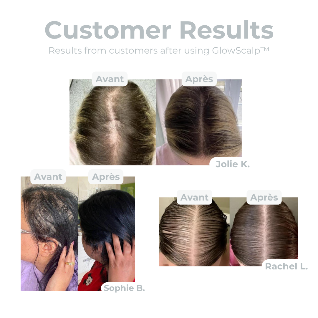 50% Rabatt | GlowScalp™ | Kopfmassagebürste