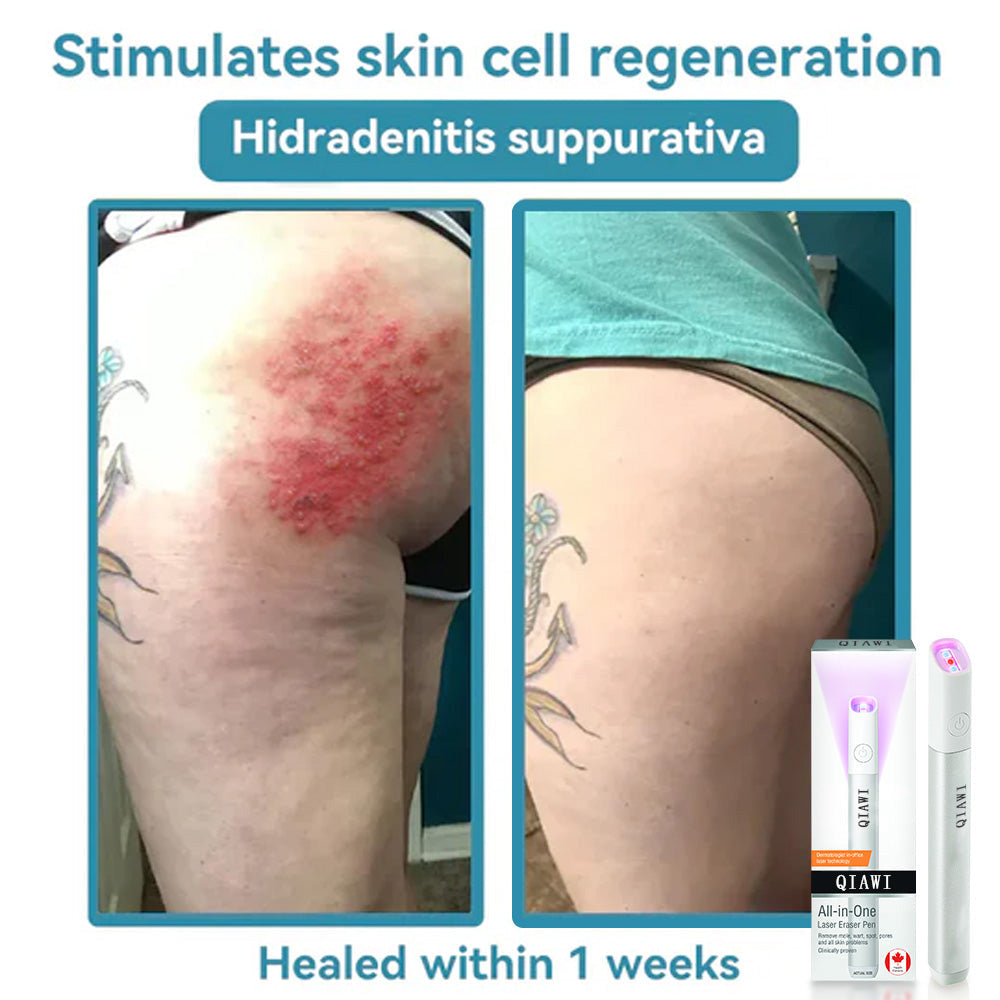 DermaLase™ | All-in-One CO₂ Laser Eraser Pen | Entfernt Muttermale, Warzen, Hautfehler &amp; Pigmentflecken