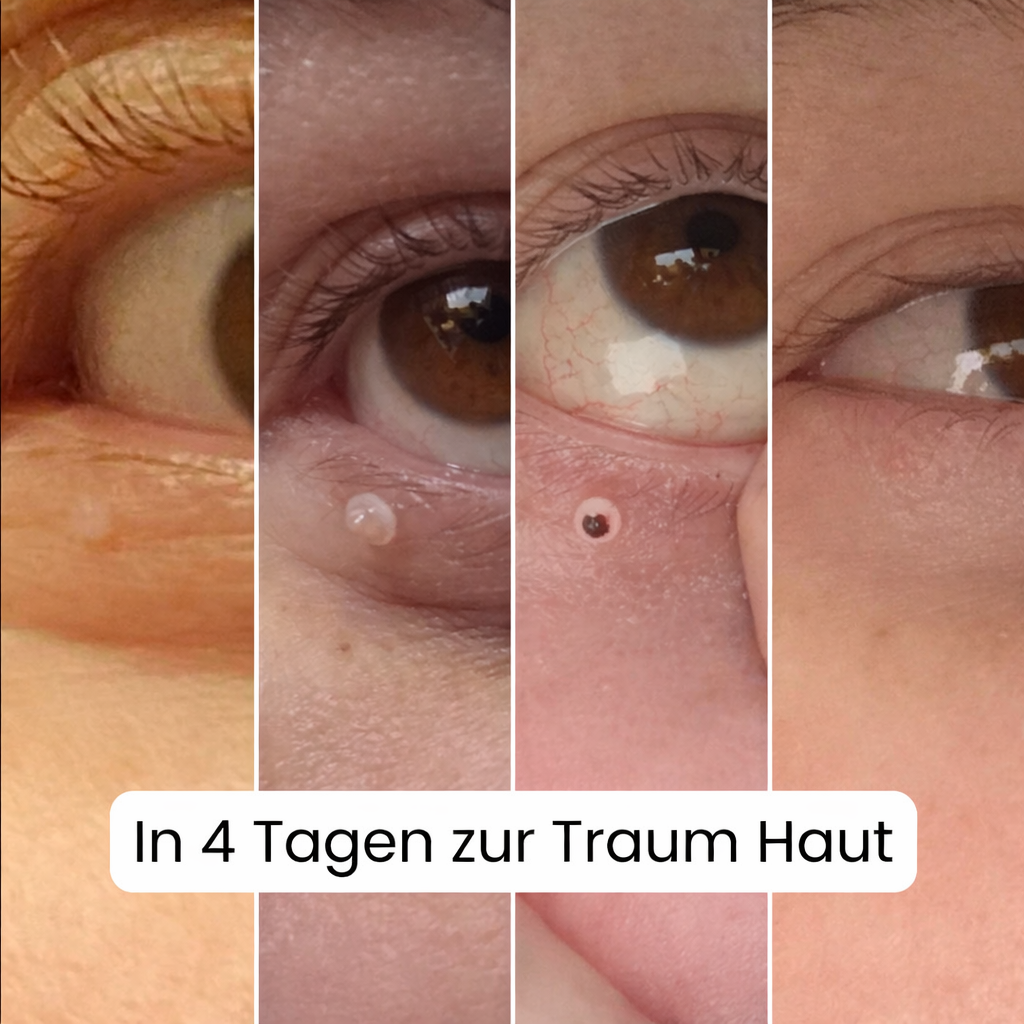 ALCURA™ | Glatte Haut in nur 4 Tagen