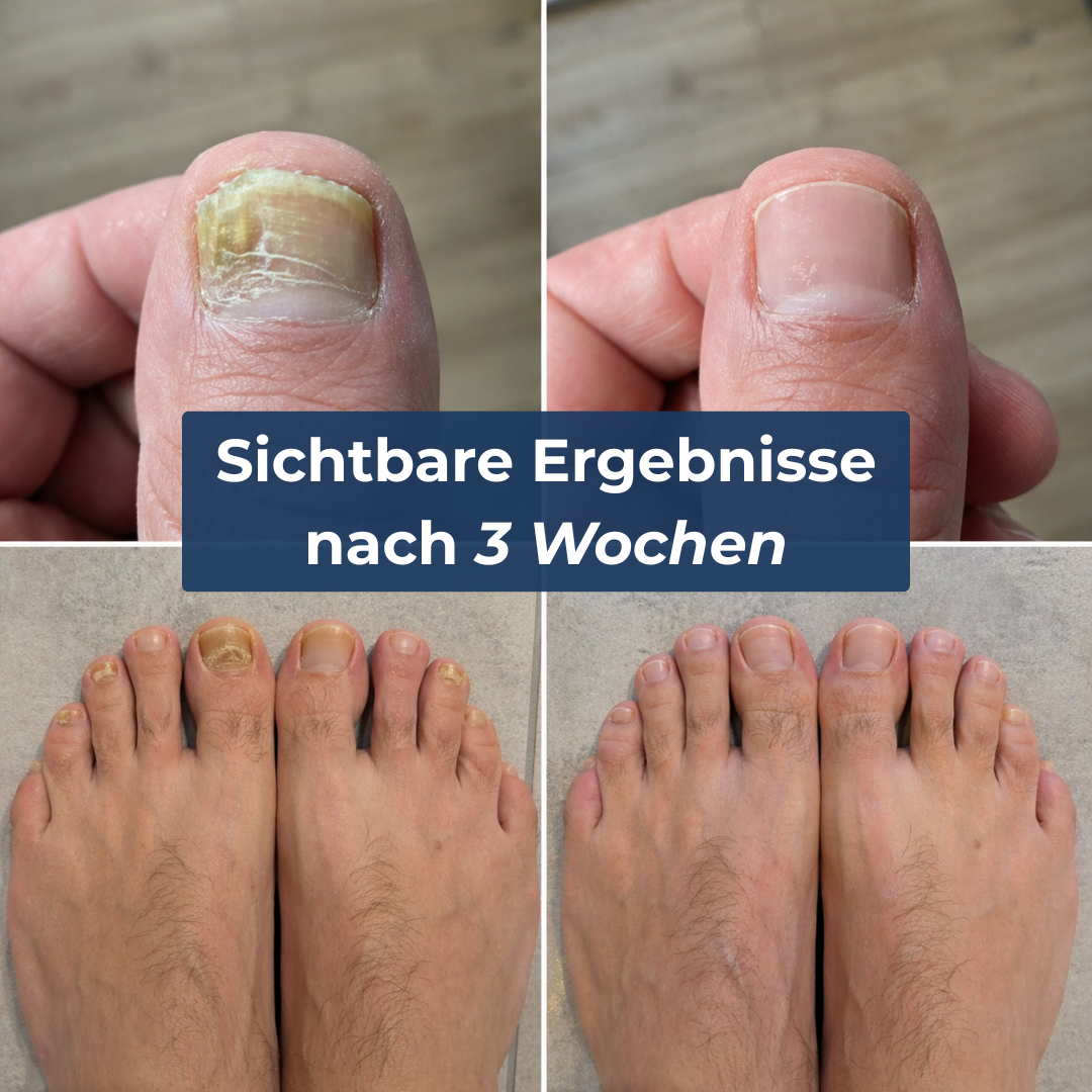 Levora | MedNail gegen jahrelangen Nagelpilz