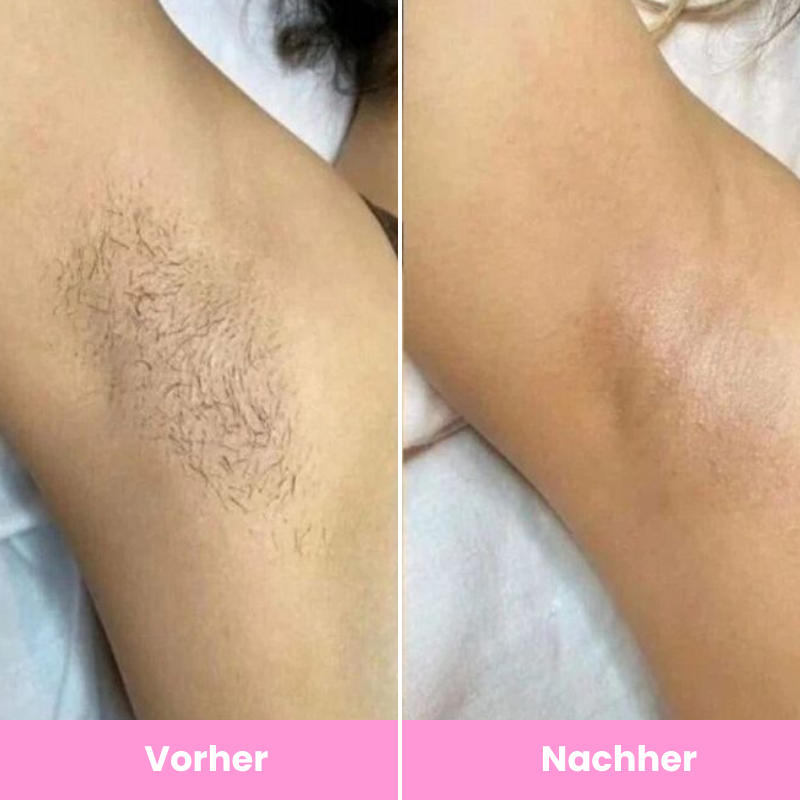 Lunelle™ Haarentfernungs-Set für glatte Haut im Sommer