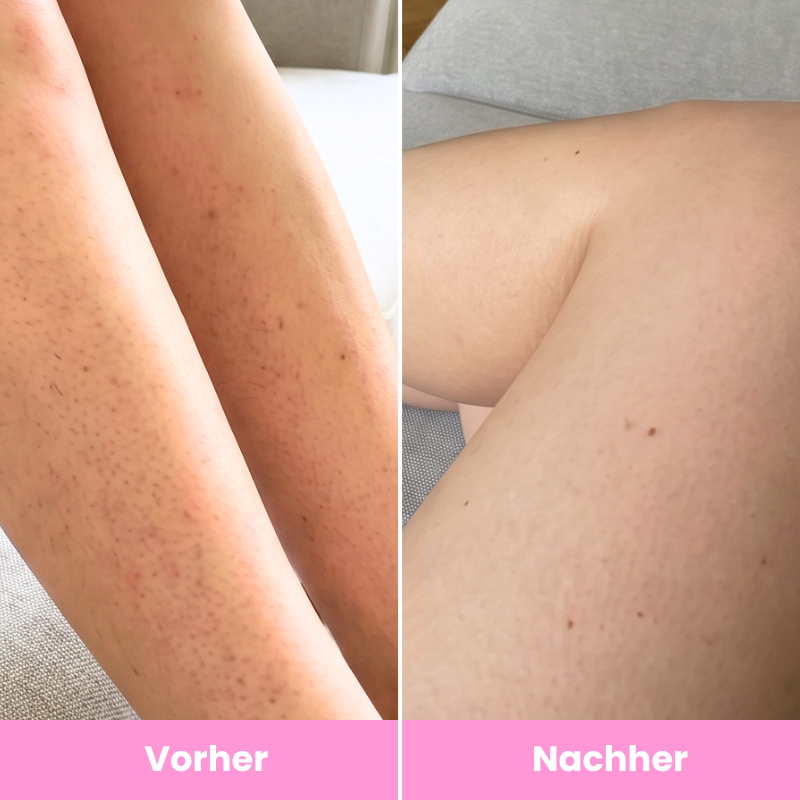 Lunelle™ Haarentfernungs-Set für glatte Haut im Sommer
