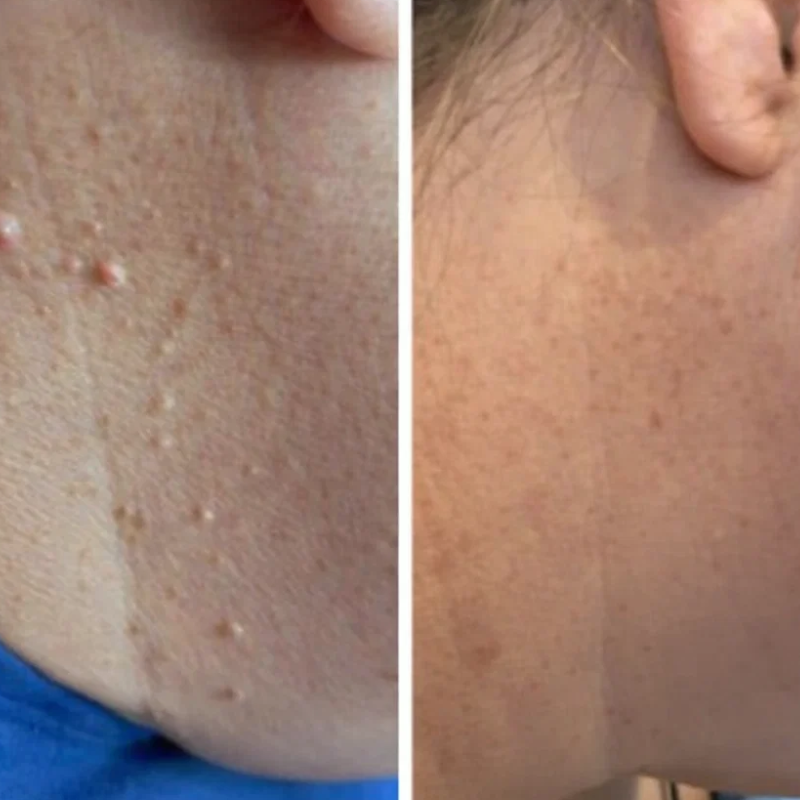 ALCURA™ | Glatte Haut in nur 4 Tagen