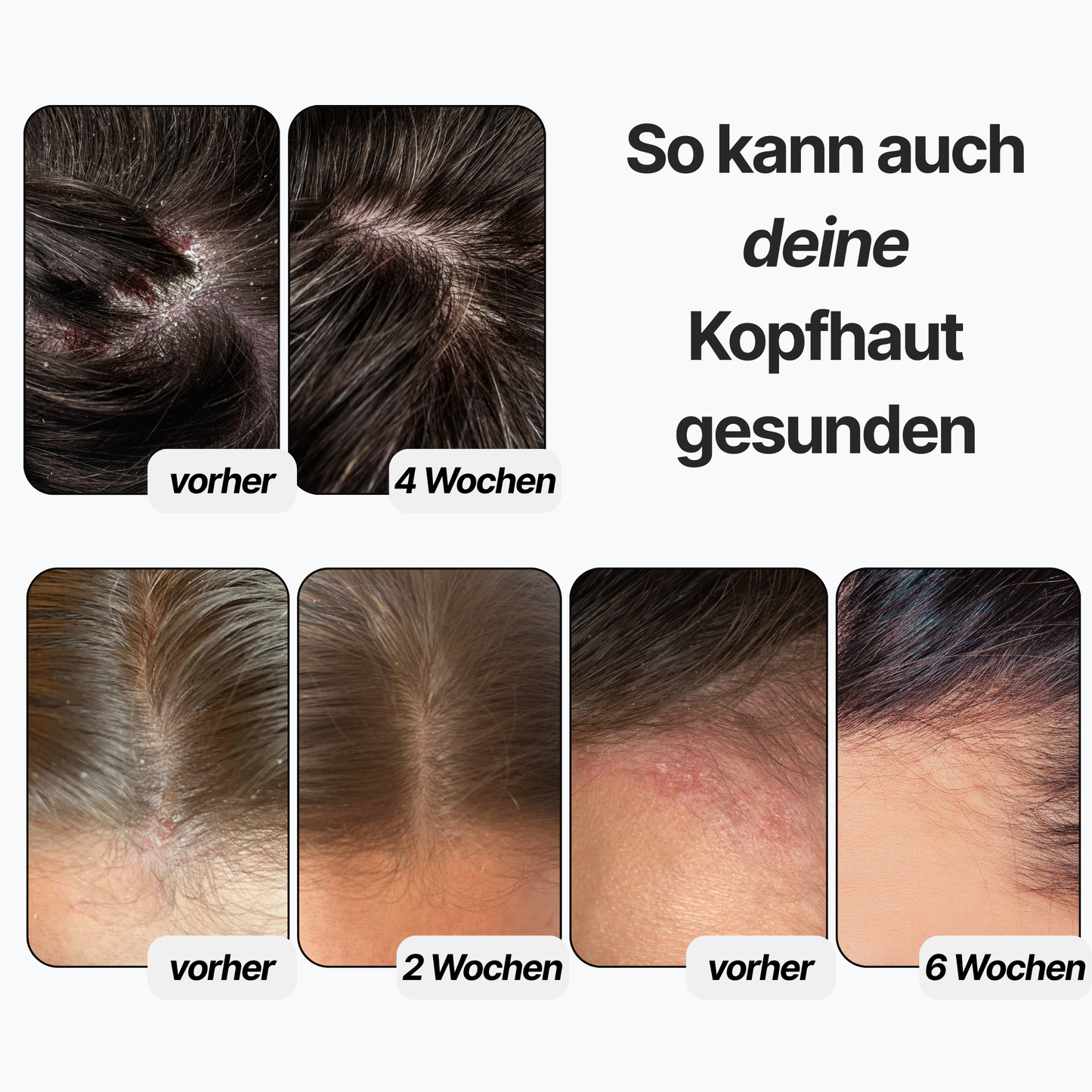 R&DETAIL® Hautpflegendes Anti-Schuppen-Shampoo für empfindliche Kopfhaut, 100 ml