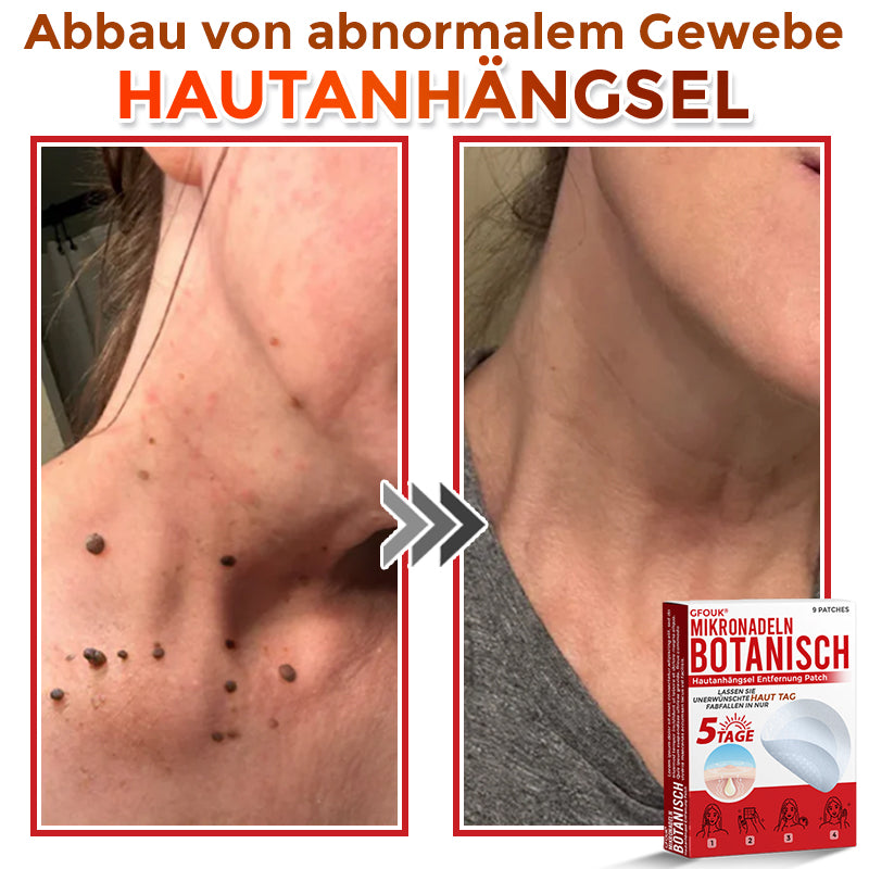 👨🏻‍⚕️🇩🇪 GFOUK® Mikronadel-Botanisches Hautanhängsel-Entfernungspflaster ✅ Hergestellt in Deutschland