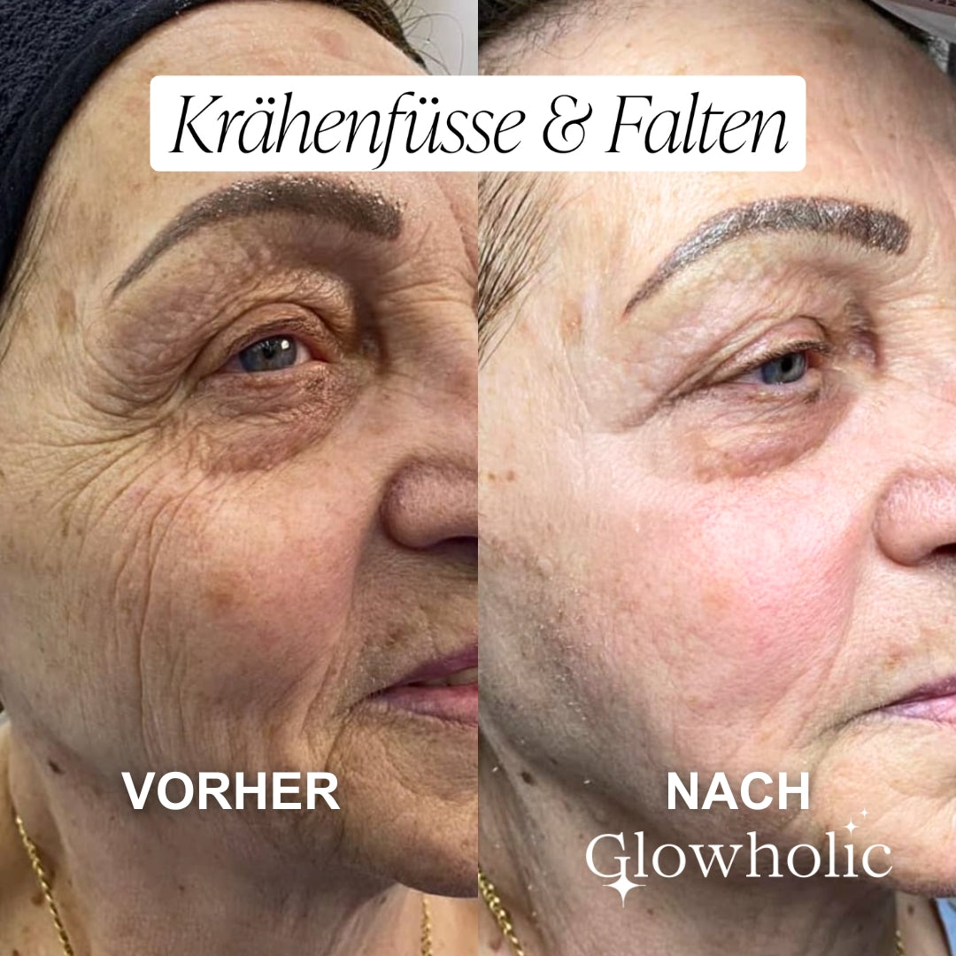 Anti-Falten Starter Set - Glowholic Micro-Needling Infusion für zuhause