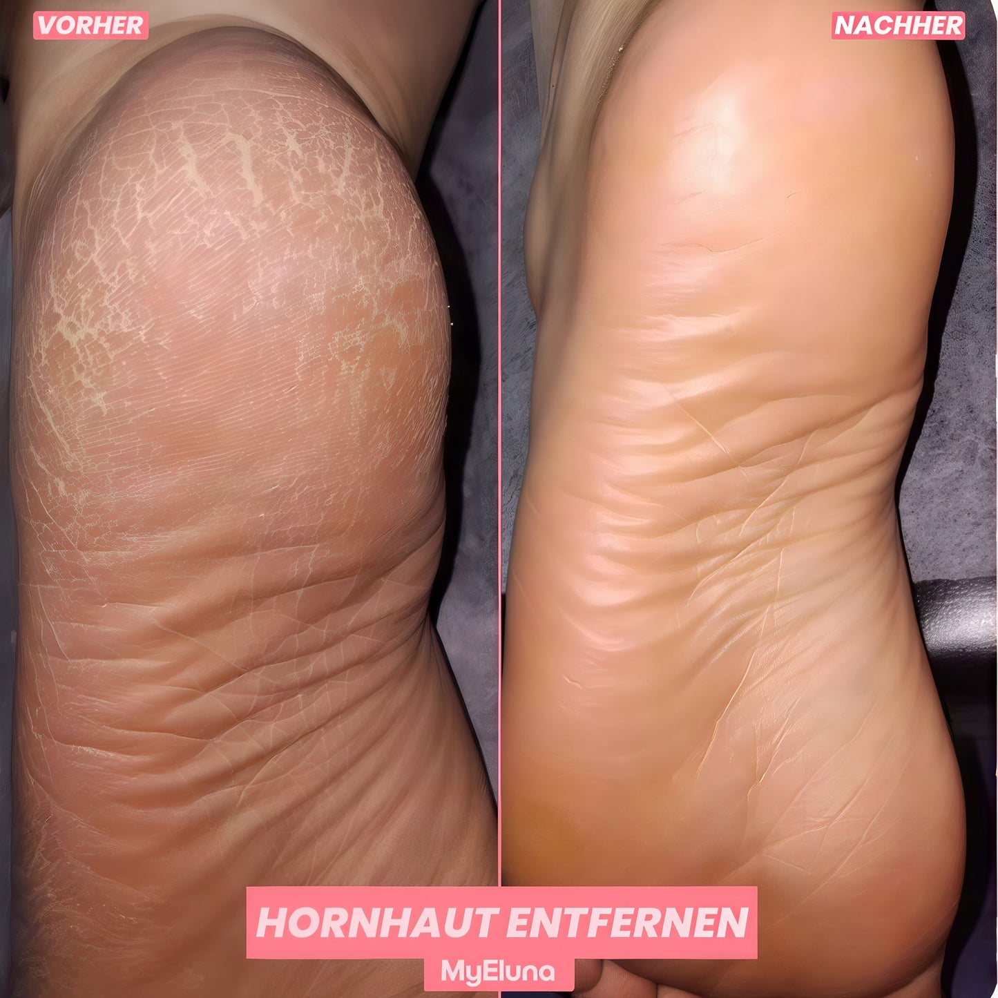FootLuxe™ – Sanftes Pflegegerät für sichtbar weichere Füße