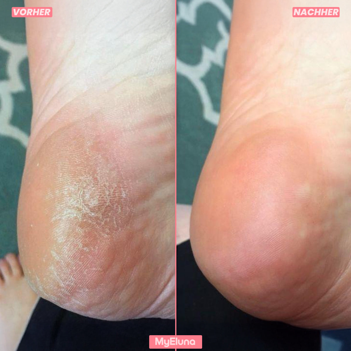 FootLuxe™ – Sanftes Pflegegerät für sichtbar weichere Füße