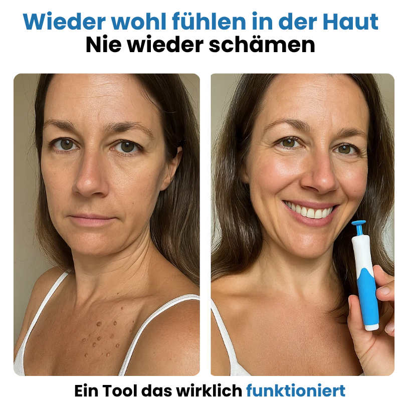 ALCURA™ | Glatte Haut in nur 4 Tagen