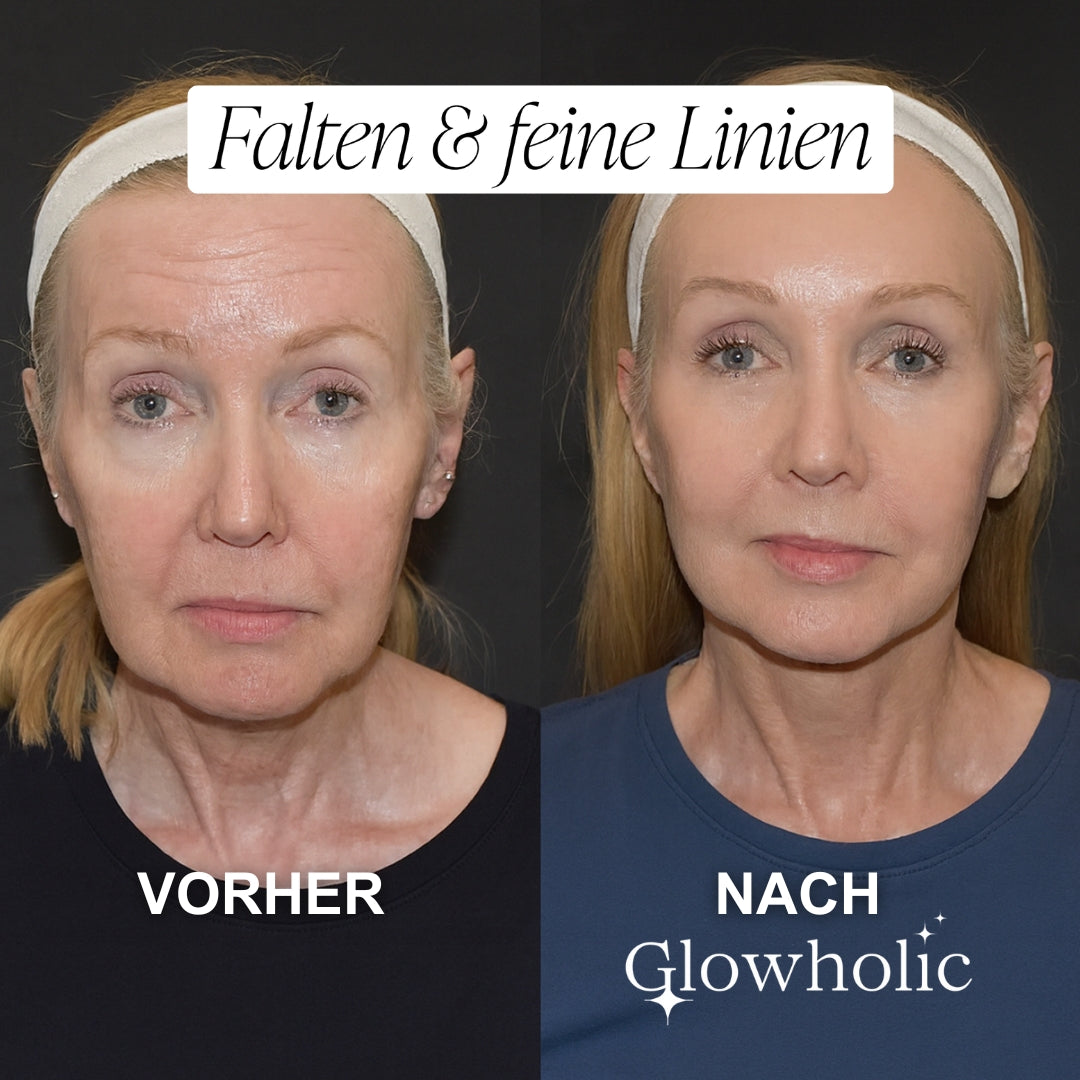 Anti-Falten Starter Set - Glowholic Micro-Needling Infusion für zuhause