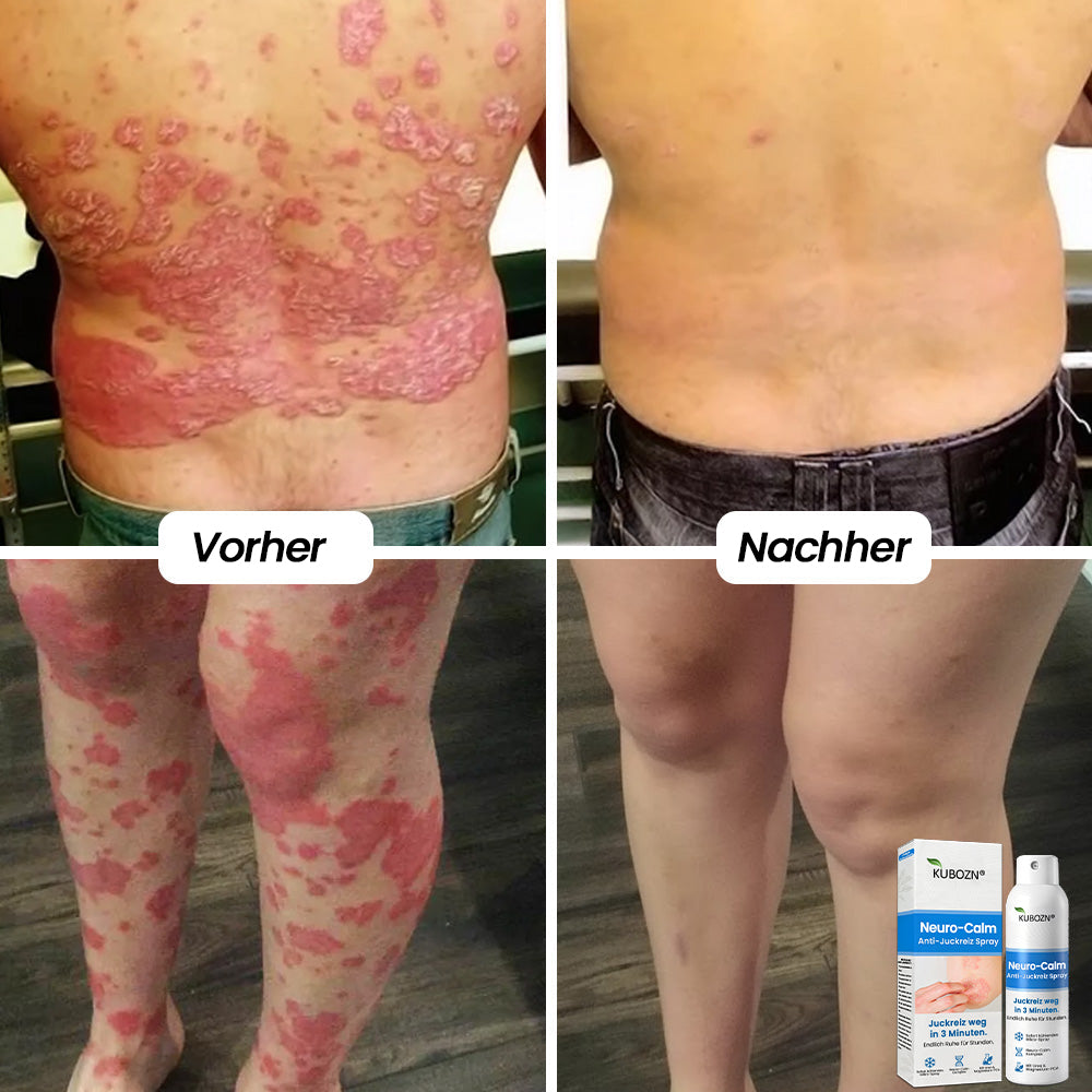DermaCalm™ – Schnelle Pflege für empfindliche, gereizte Haut | 2 Flashen Bundle